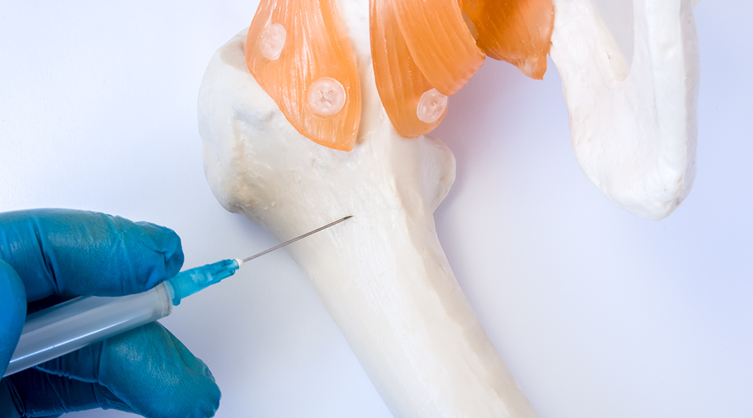 Bone Marrow Biopsy: What is it and What Can it Identify?